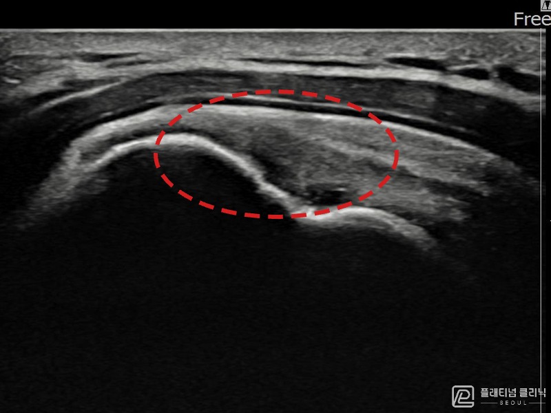 김ㅇㅇ님 시술 후