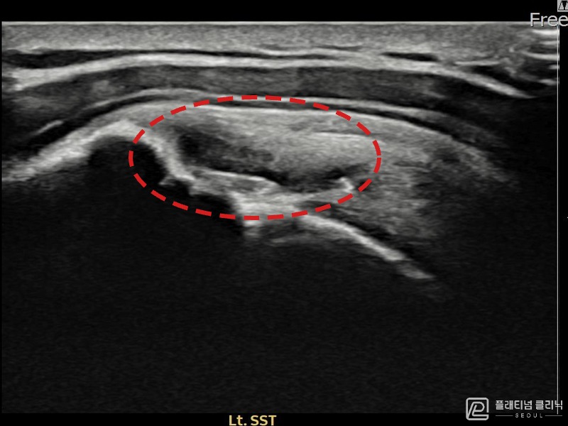 김ㅇㅇ님 시술 전