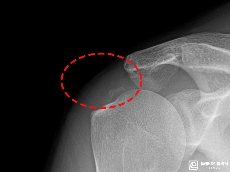 박ㅇㅇ님 시술 후