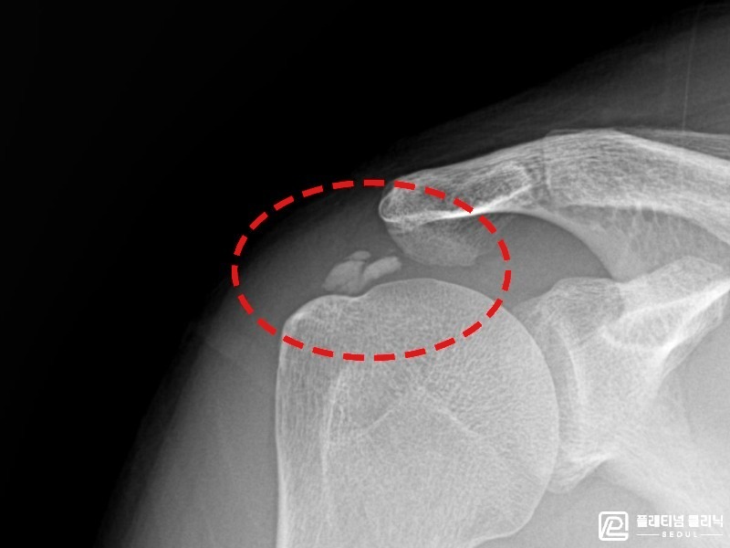 박ㅇㅇ님 시술 전