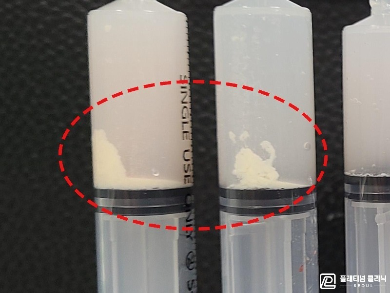 박ㅇㅇ님 제거된 석회 사진