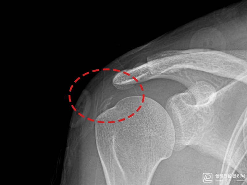 김ㅇㅇ님 시술 후