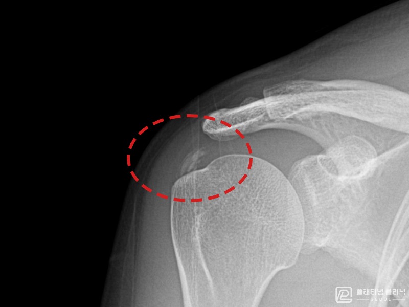 김ㅇㅇ님 시술 전