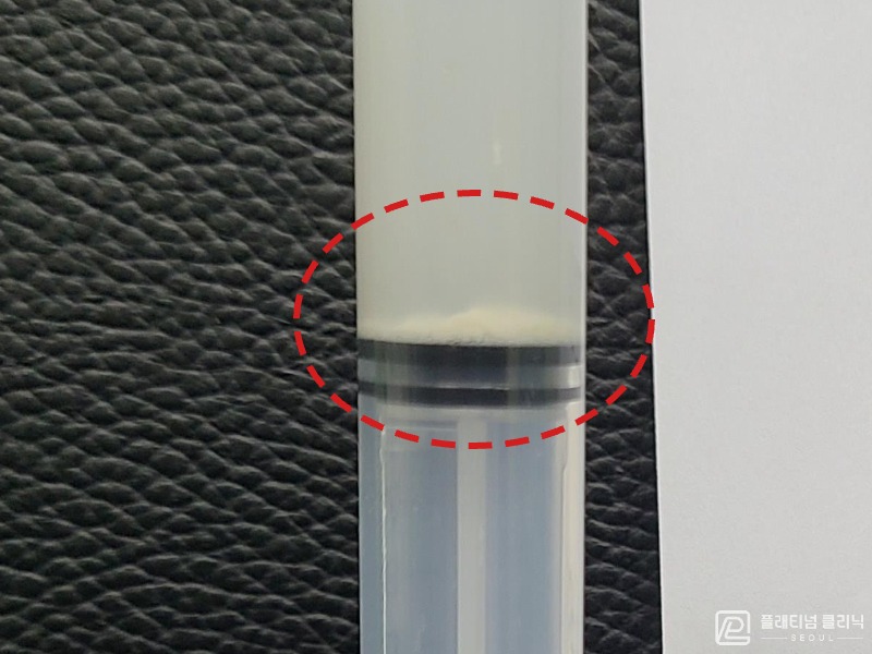 김ㅇㅇ님 제거된 석회 사진