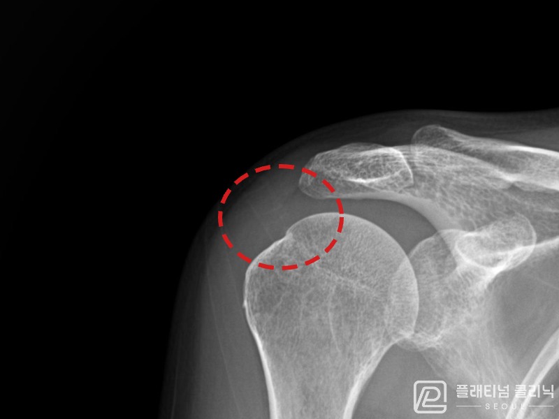 김ㅇㅇ님 시술 후