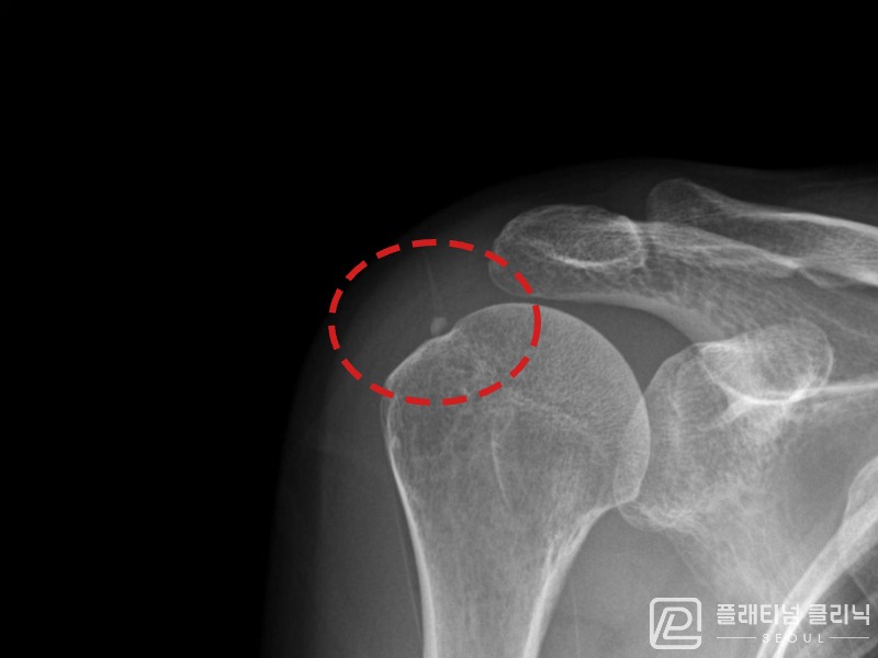 김ㅇㅇ님 시술 전