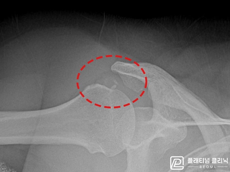 김ㅇㅇ님 시술 후