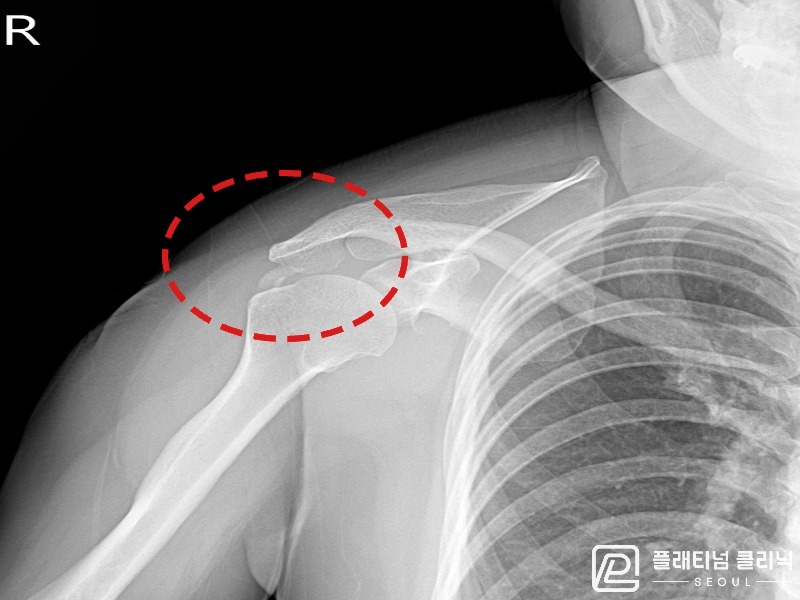 김ㅇㅇ님 시술 전