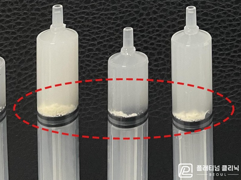 김ㅇㅇ님 제거된 석회 사진
