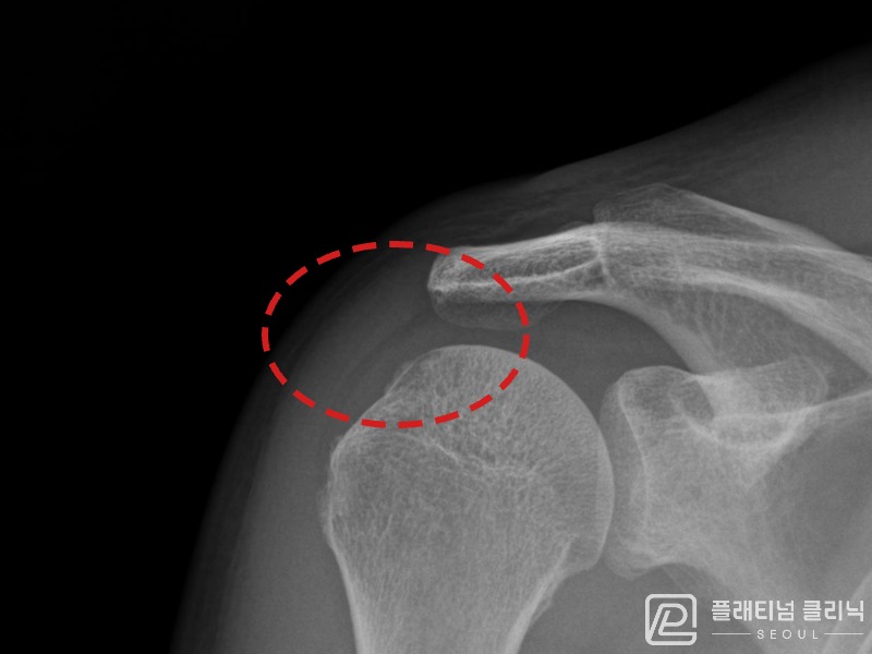 이ㅇㅇ님 시술 후