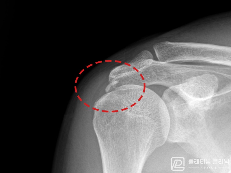 이ㅇㅇ님 시술 전