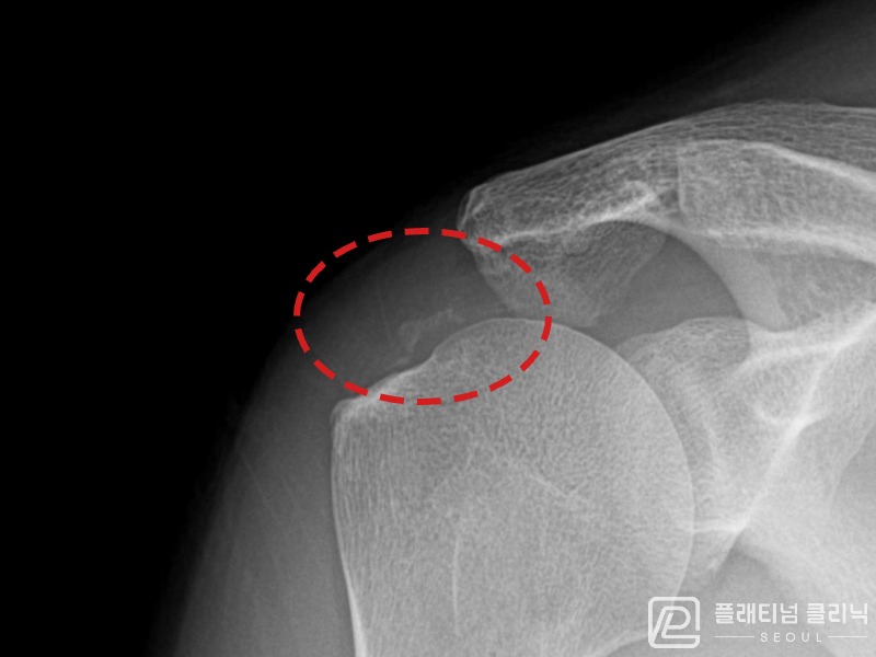 권ㅇㅇ님 시술 후