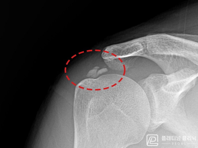 권ㅇㅇ님 시술 전