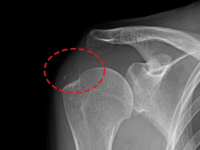 신ㅇㅇ님 시술 후