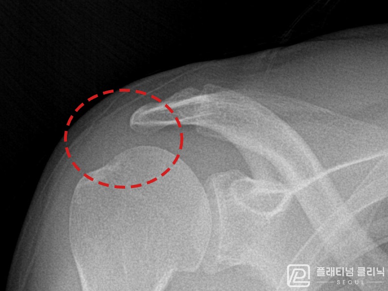 이ㅇㅇ님 시술 후