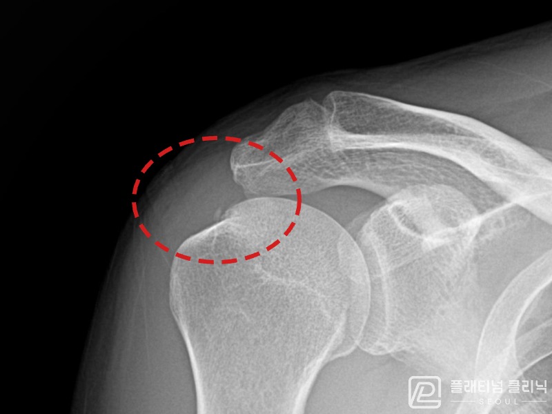 이ㅇㅇ님 시술 전