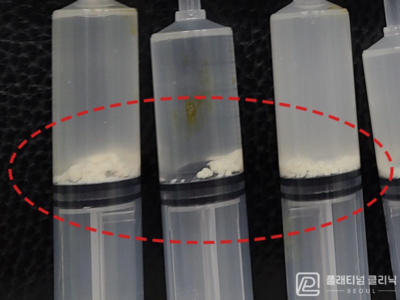 이ㅇㅇ님 제거된 석회 사진