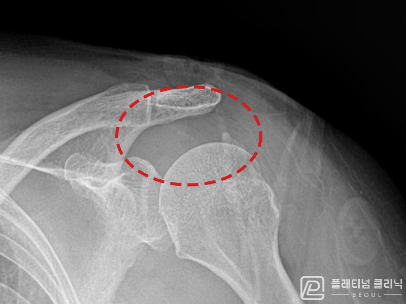 이ㅇㅇ님 시술 후