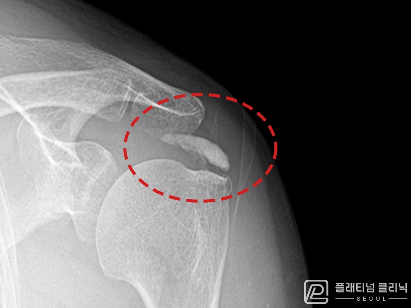 이ㅇㅇ님 시술 전