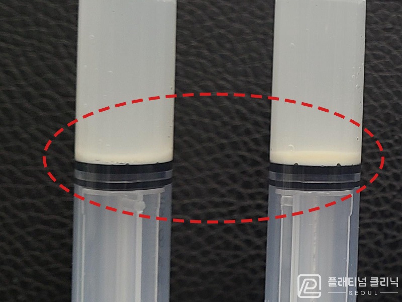 이ㅇㅇ님 제거된 석회 사진
