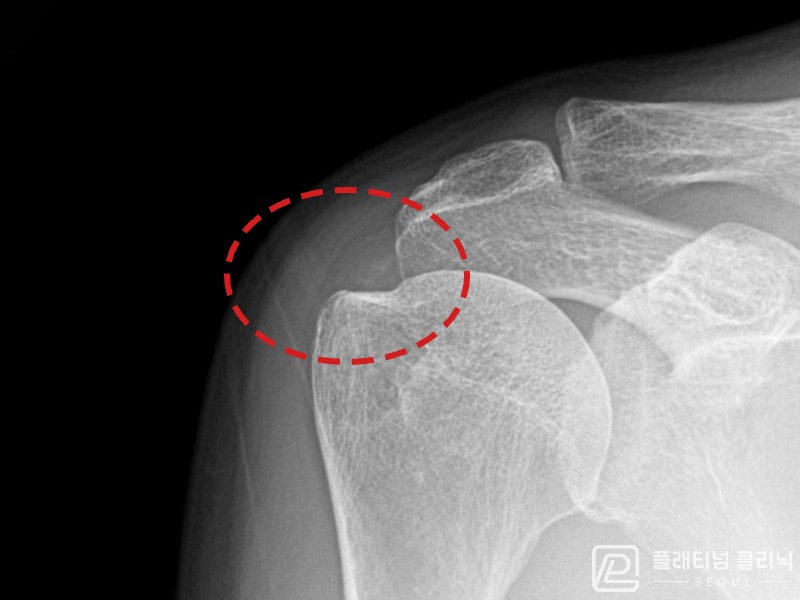 이ㅇㅇ님 시술 후