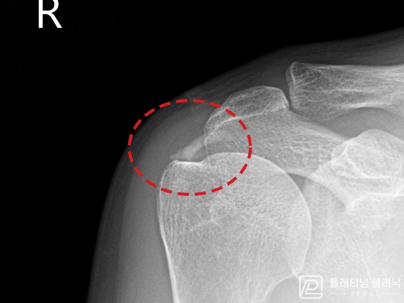 이ㅇㅇ님 시술 전