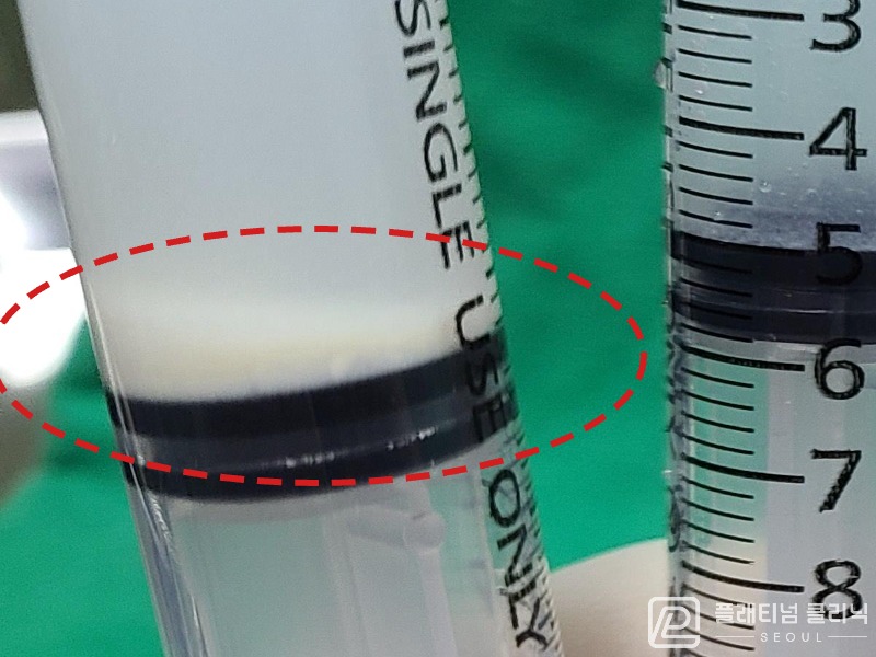 이ㅇㅇ님 제거된 석회 사진