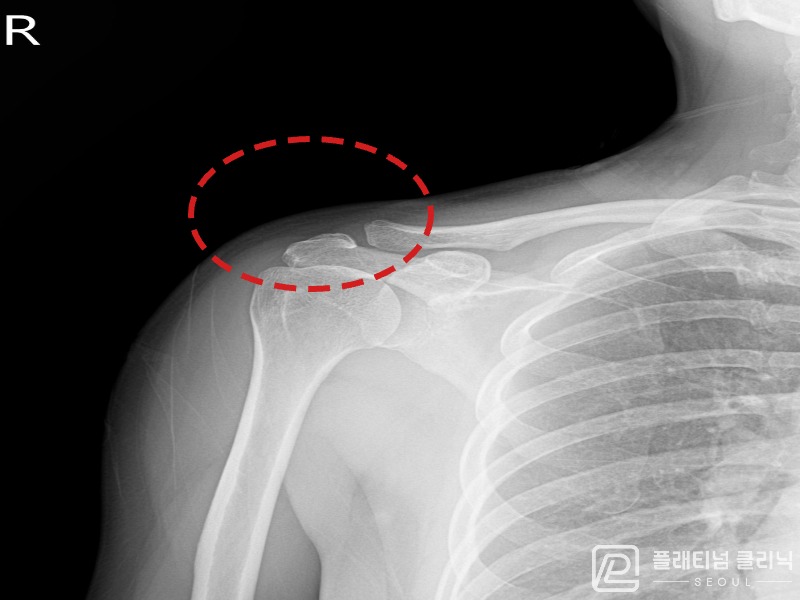 이ㅇㅇ님 시술 후