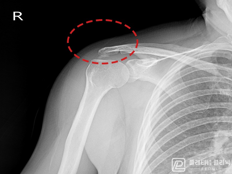 이ㅇㅇ님 시술 전