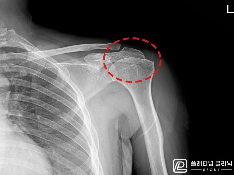 이ㅇㅇ님 시술 후