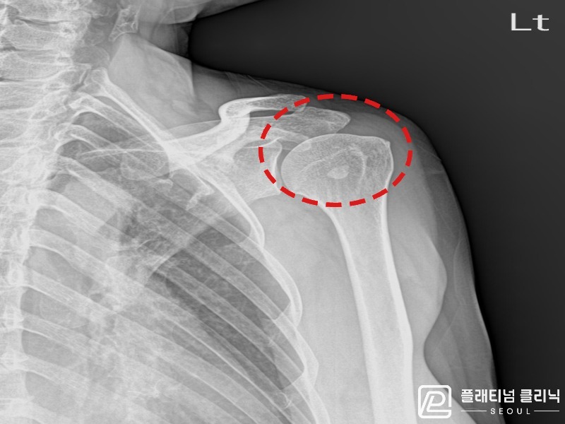 이ㅇㅇ님 시술 전