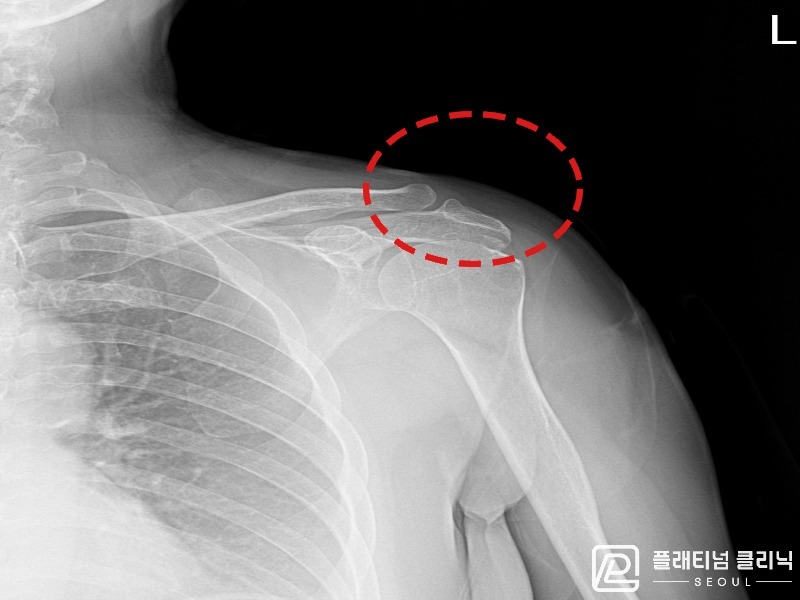 이ㅇㅇ님 시술 후