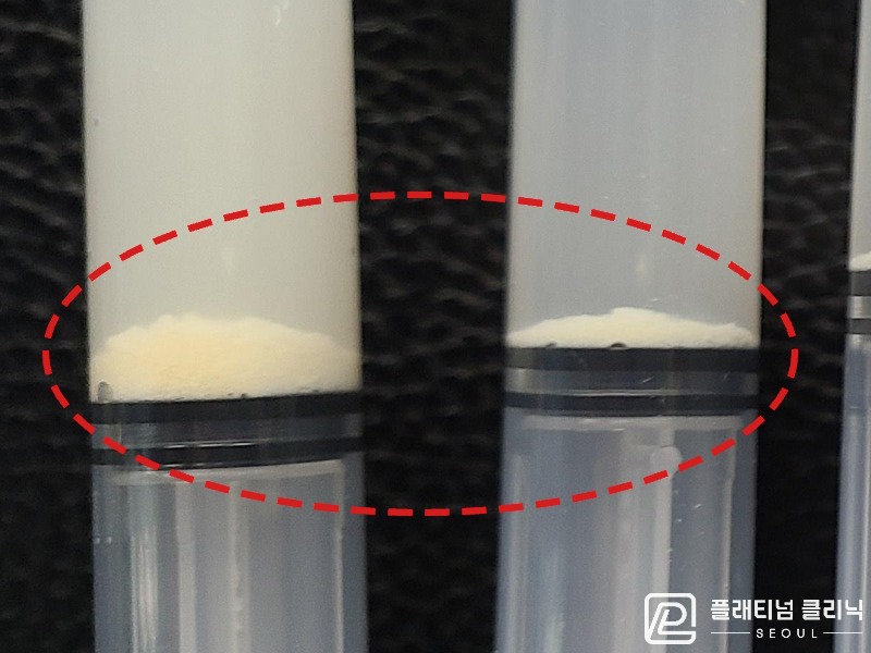 이ㅇㅇ님 제거된 석회 사진