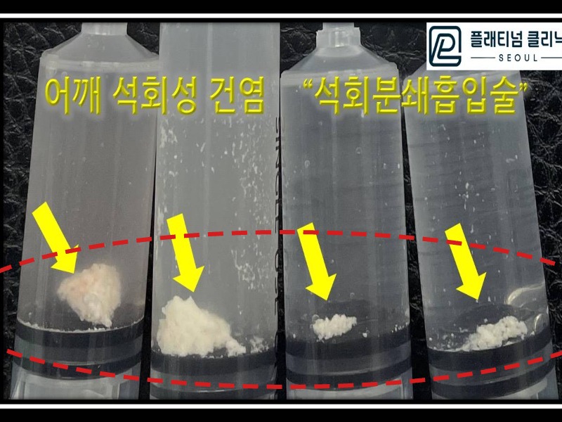 전ㅇㅇ님 제거된 석회 사진