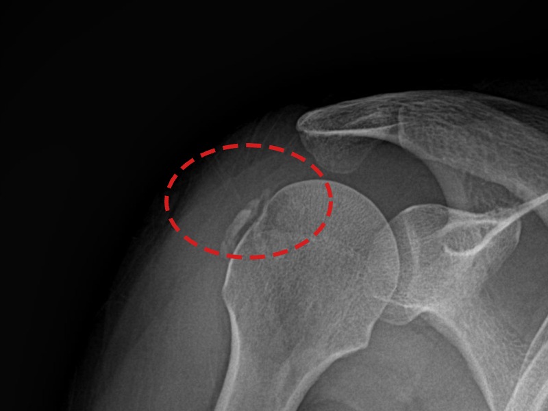 정ㅇㅇ님 시술 후