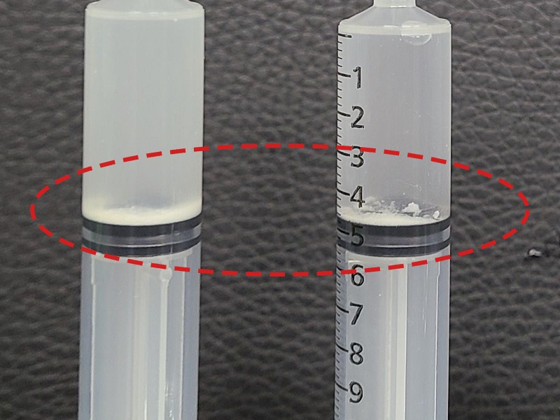정ㅇㅇ님 제거된 석회 사진