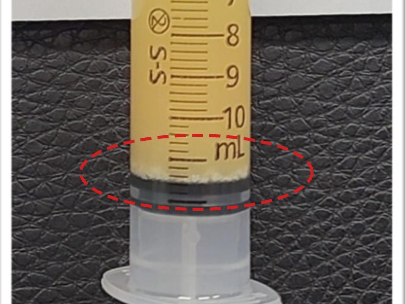 조ㅇㅇ님 제거된 석회 사진