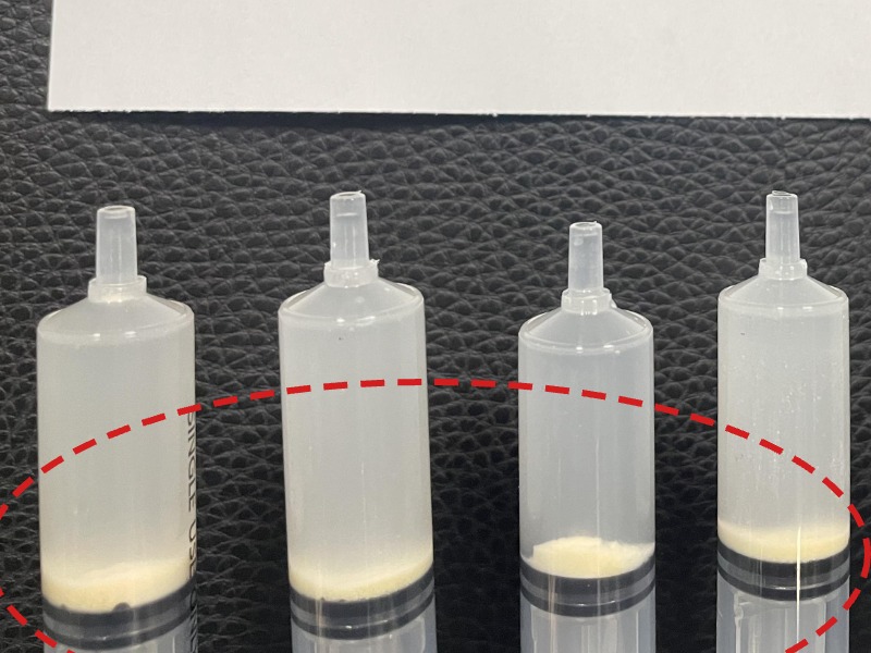 한ㅇㅇ님 제거된 석회 사진